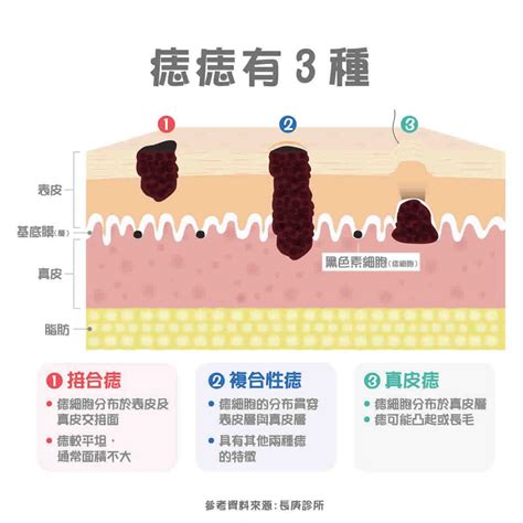 胸部長痣|痣變大、痣多或長毛會變皮膚癌？認識痣的形成與原因